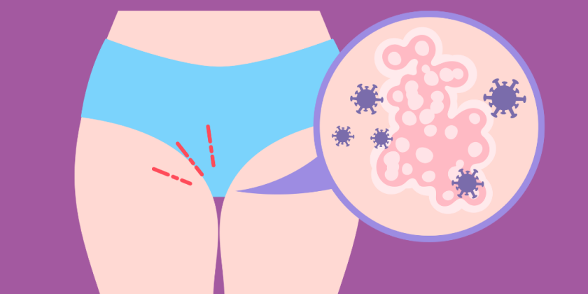 Yeast Infection or Lichen Sclerosus: Why So Many Misdiagnoses?
